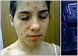  Noiva adia seu casamento por causa de catapora