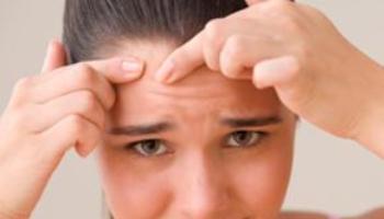 Acne também é problema de adulto