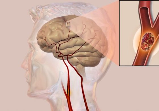 Prevenção de aneurismas cerebrais é pouco conhecida pela população