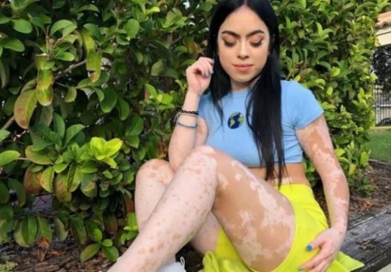 Jovem com vitiligo transforma o corpo em obra de arte: “Isso é poderoso”