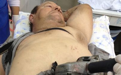 Passa bem agricultor que viajou 50 km com serra elétrica cravada na barriga no Sul
