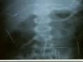 Cirurgia retira últimas agulhas de garoto