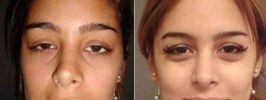 Clínica divulga fotos de Larissa Riquelme antes de plásticas