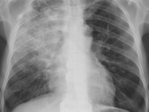 Radiografia de pulmão diagnosticado com pneumonia. (Yale Rosen / Creative Commons)