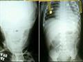 Menino com agulhas no corpo é transferido