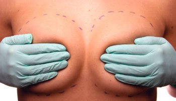 Os cuidados antes de colocar o silicone